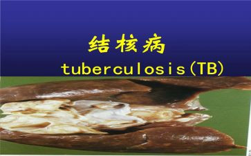 结核防治工作计划7篇